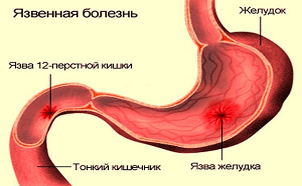 Язва желудка картинки для детей