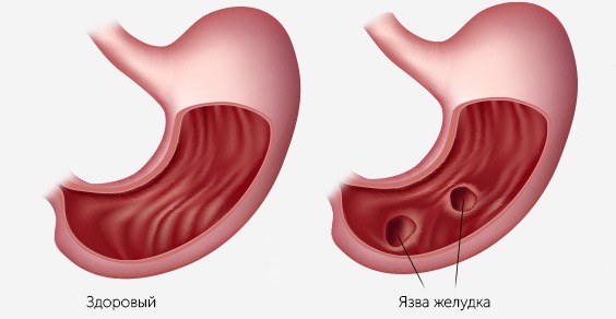 Язвенная болезнь желудка рисунок