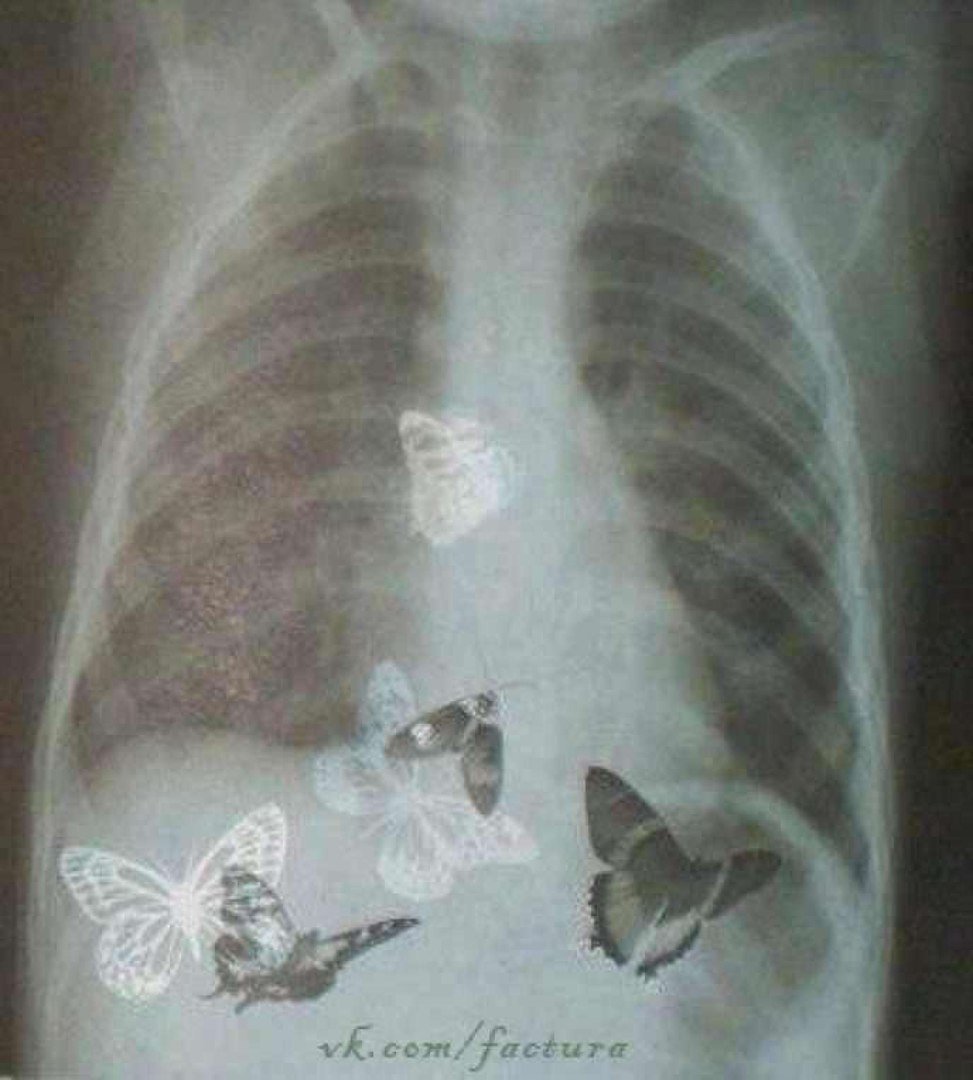 Бабочки в животе рентген